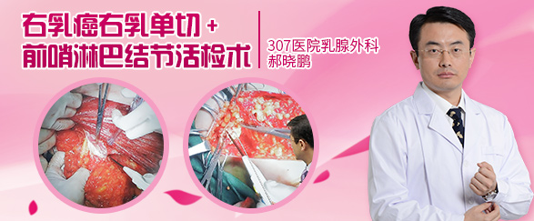 前哨淋巴结活检