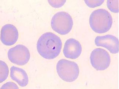 疟疾感染多数竟然是复发!