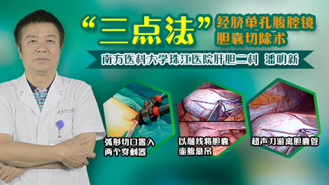 经脐单孔腹腔镜