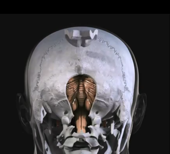 髓母细胞瘤切除