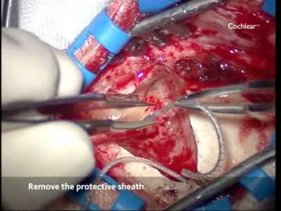 人工耳蜗植入