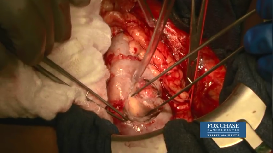 开放性肾脏部分切除