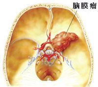 脑膜瘤