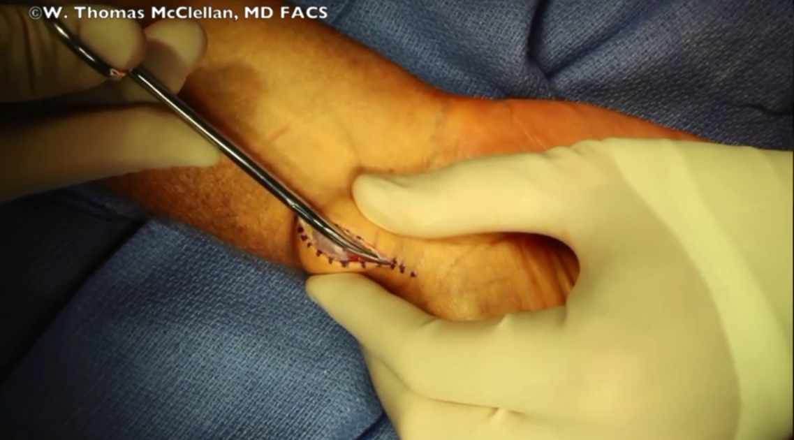 手腕神经节囊肿摘除