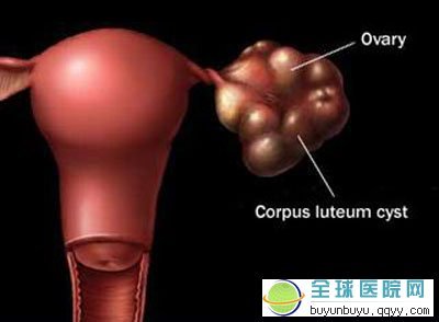 子宫输卵管通液、双侧卵巢巧囊剥除术
