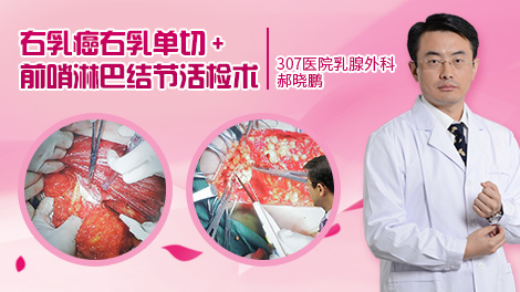 前哨淋巴结活检